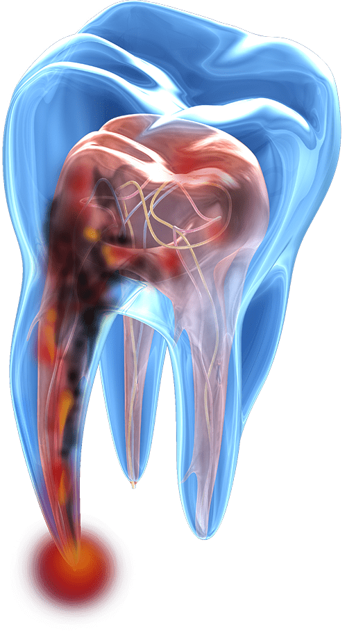 3D infected tooth graphic