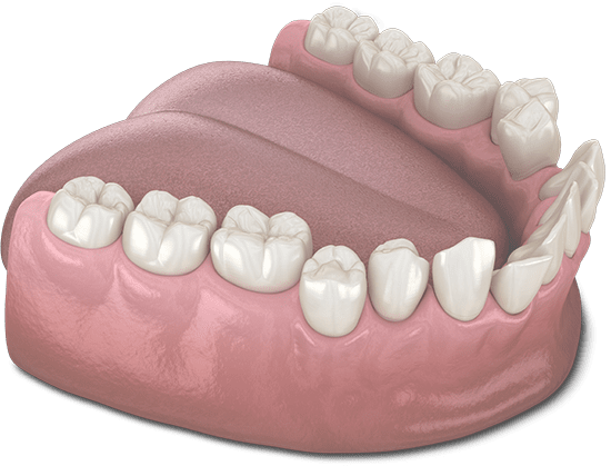 crooked teeth graphic
