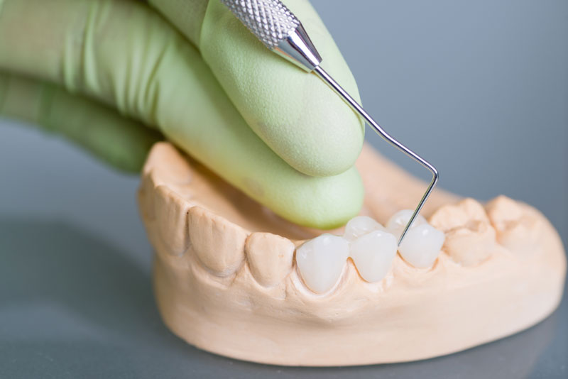 dental bridge model being examined