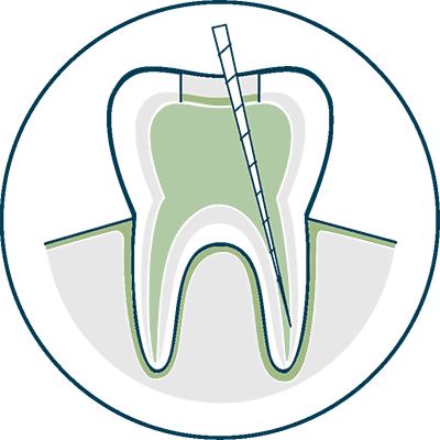 root canal in progress icon