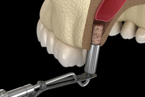 sinus lift graphic