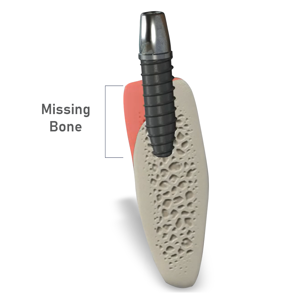 bone graft model
