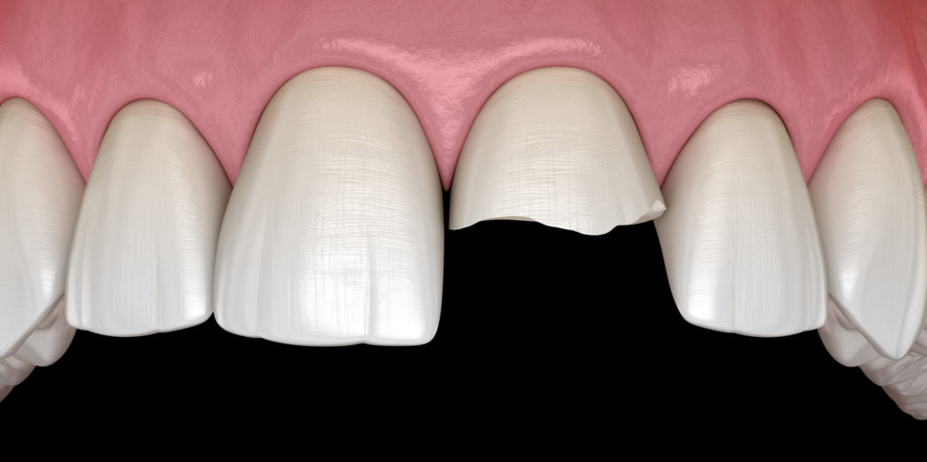 3d model of a broken tooth