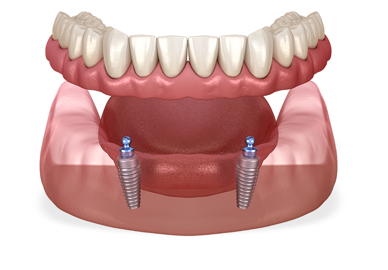 implant-supported denture model