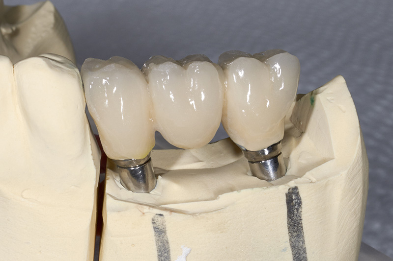 implant-supported dental bridge