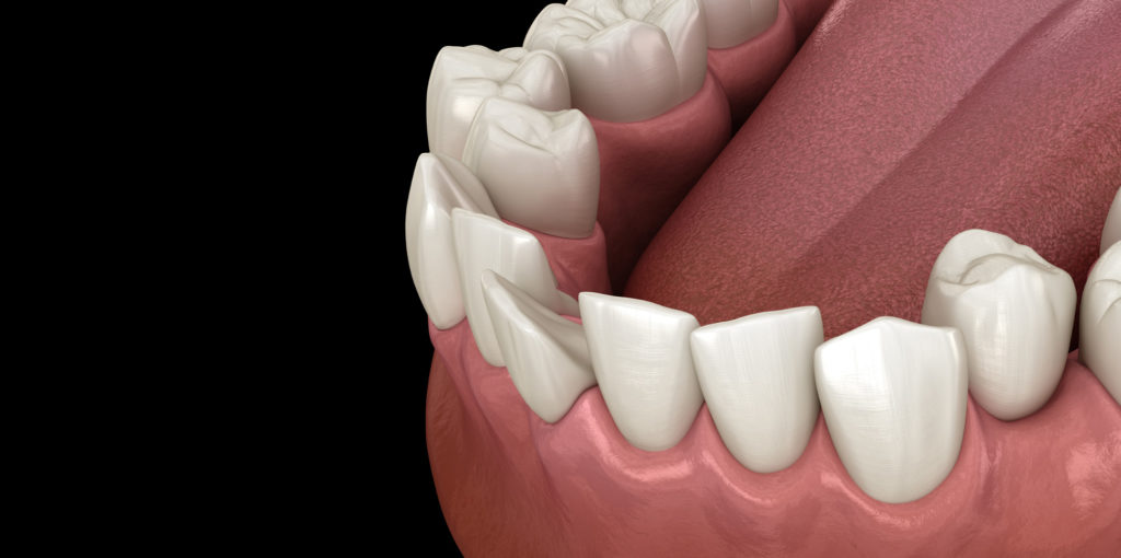 smile with crooked teeth