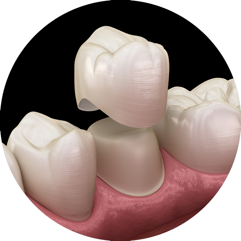 3D dental crown model