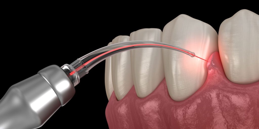 dental laser being used