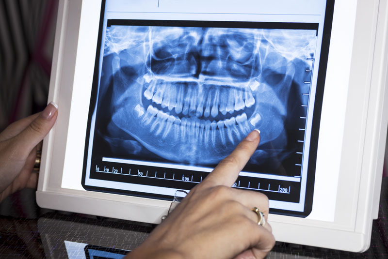 dental X-ray shows impacted wisdom teeth