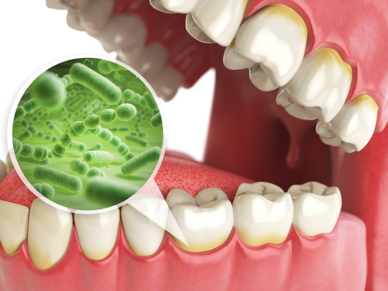 gum disease causing bacteria