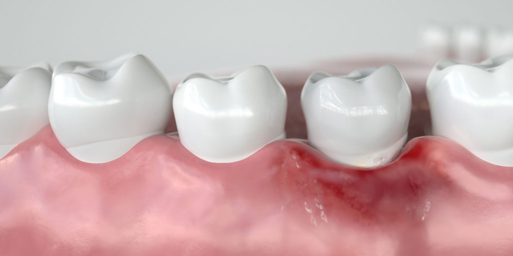 model of gum disease