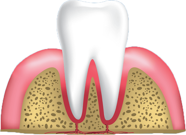 stage 1 of gum disease