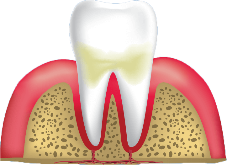 stage 2 of gum disease