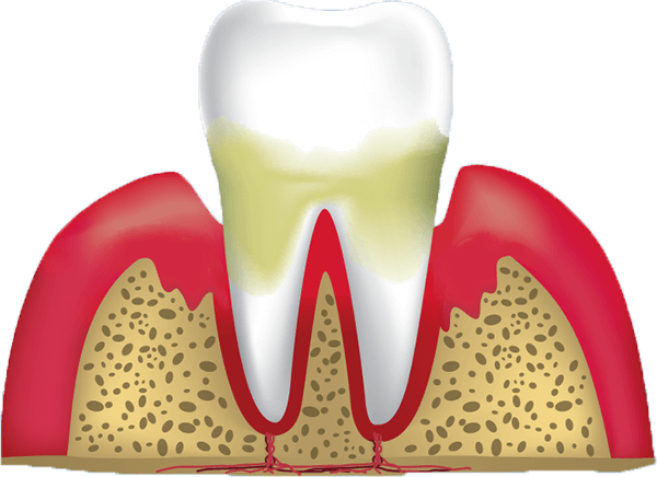 stage 3 of gum disease