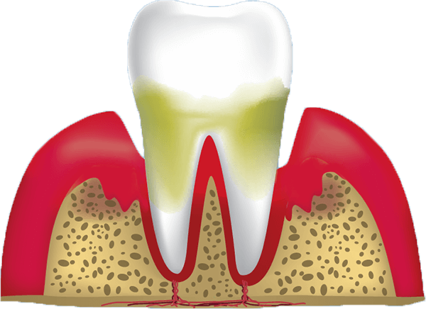 stage 4 of gum disease
