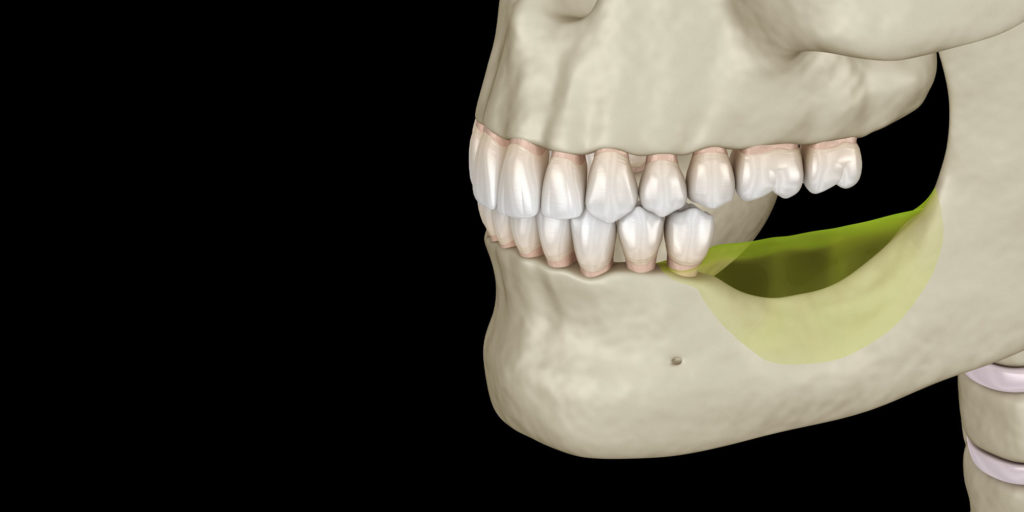 diagram of jaw bone loss
