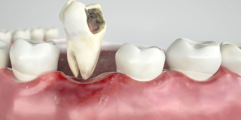 graphic of a decayed tooth