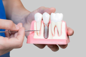 Dental Assistant Showing Off A Dental Implant In A Jawbone Cutaway Model in Oakdale, PA