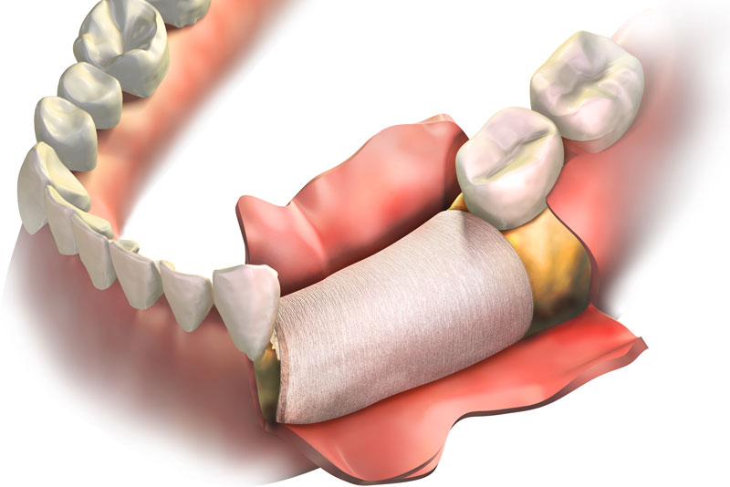 jawline skin being pulled back to show the underlying bone graft.