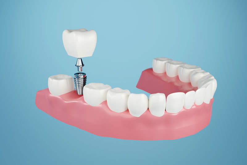 3d model of a lower jaw with a dental implant in the molars.