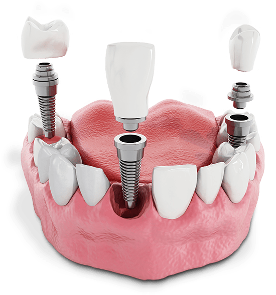 Dental implants model