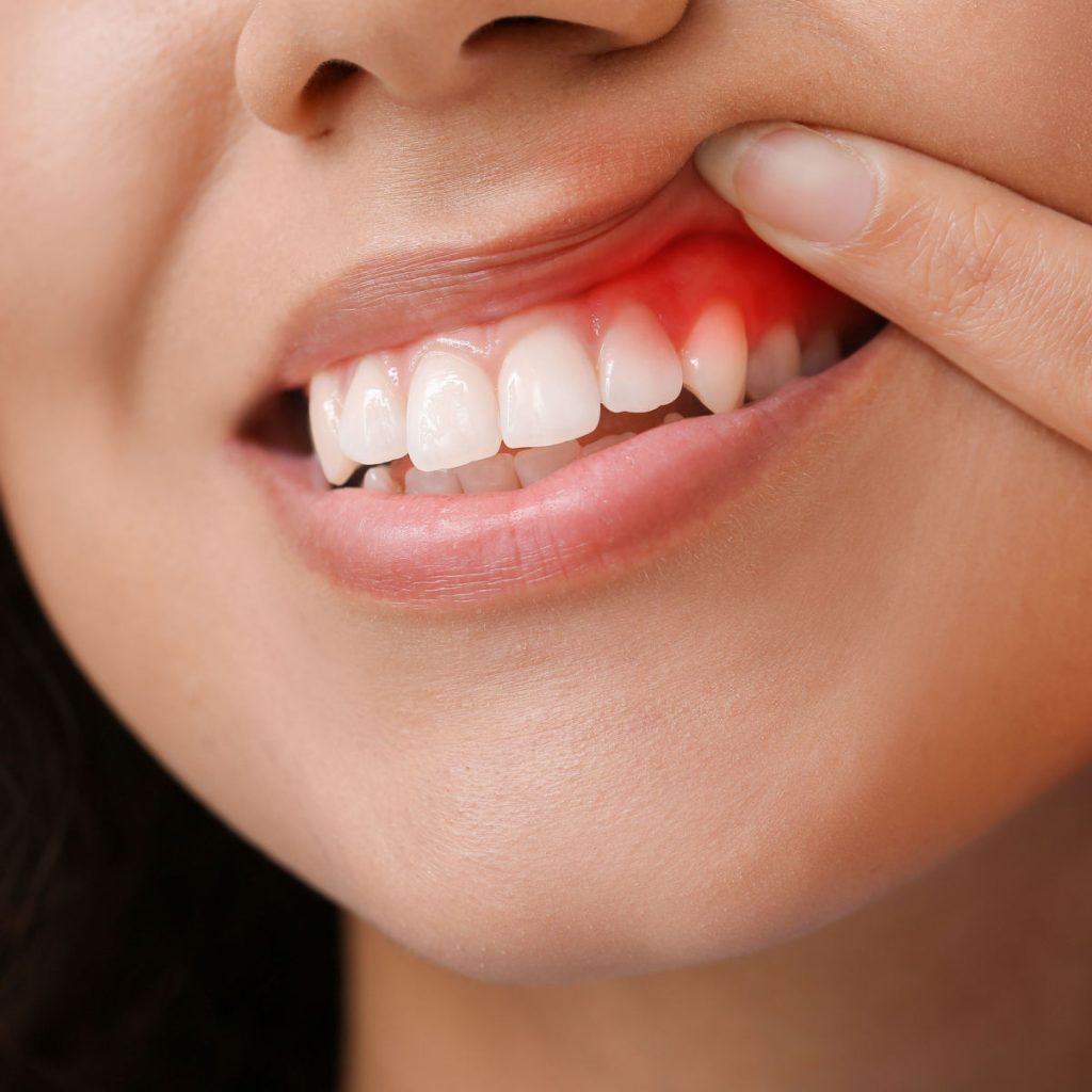 signs of gum disease