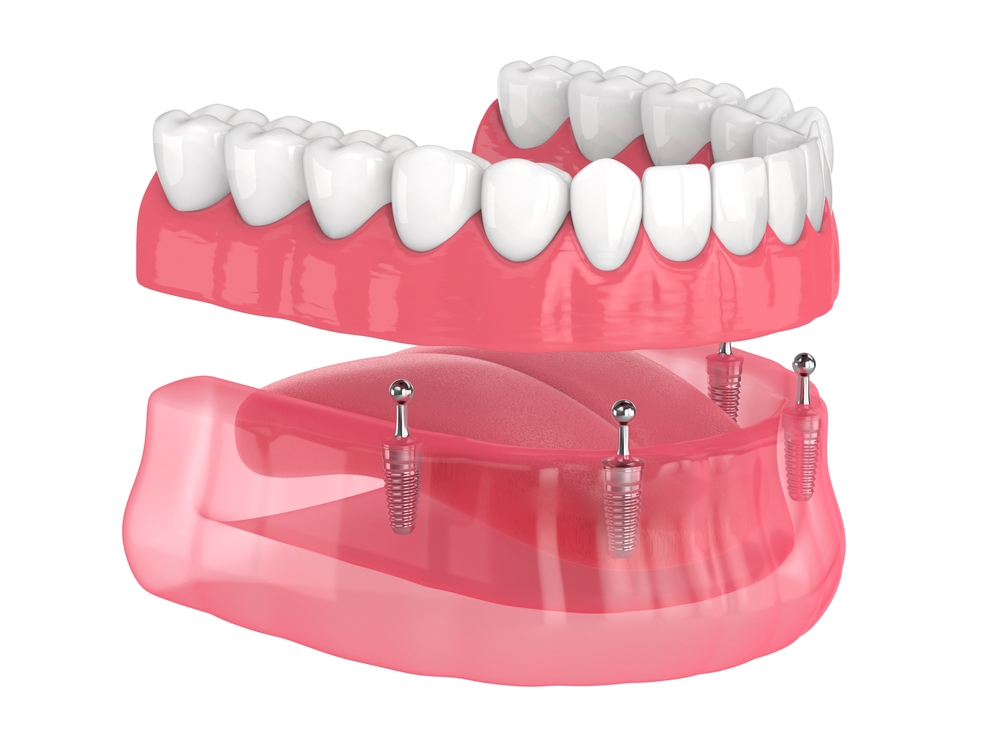 removable overdenture