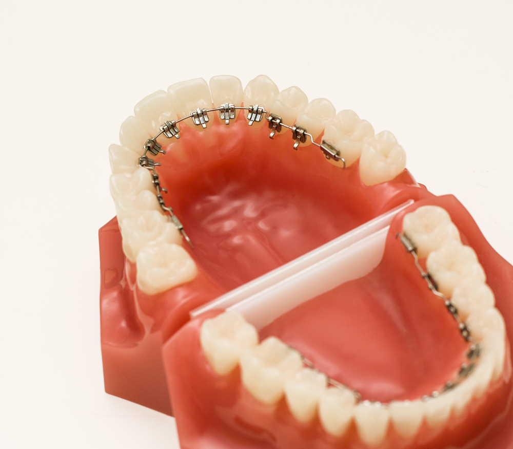 lingual braces on model teeth