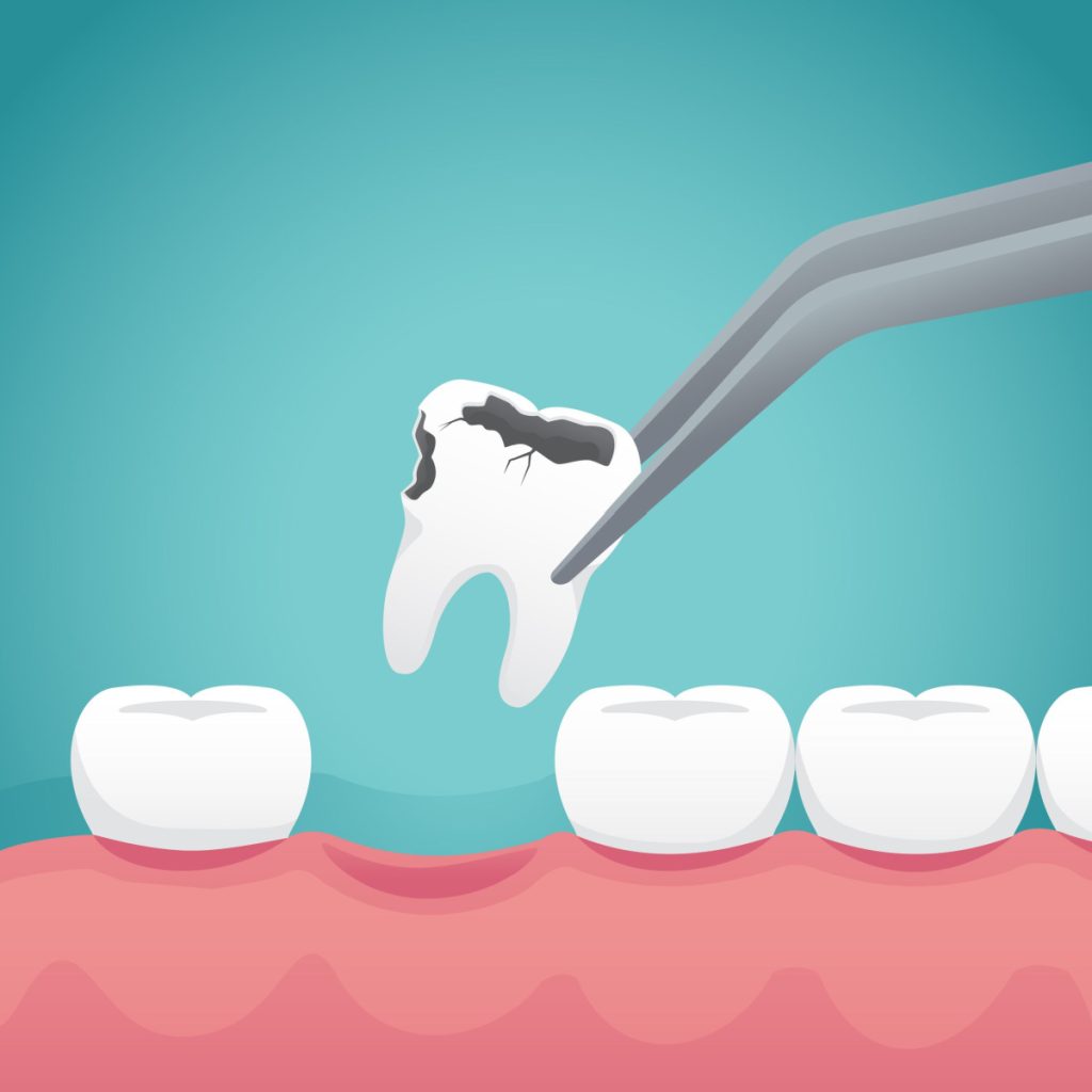 extraction of a decayed tooth